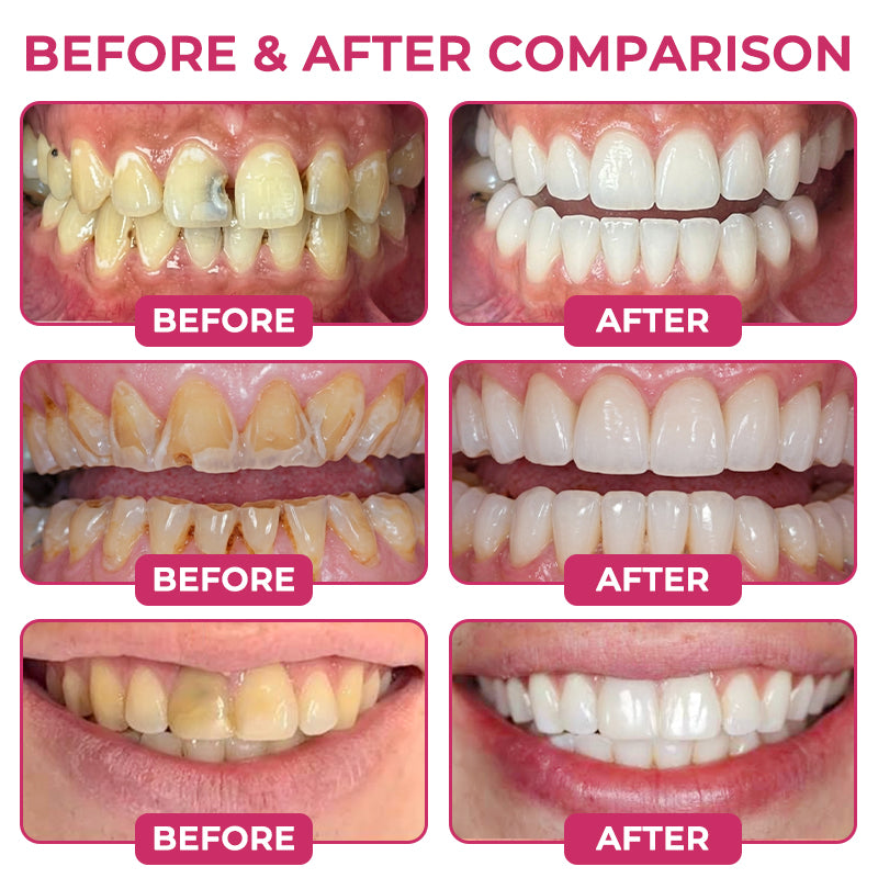 TAILEDEN®Cavity-Repair Natural Enamel Filling Gel