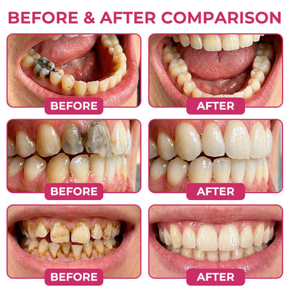 TAILEDEN®Cavity-Repair Natural Enamel Filling Gel